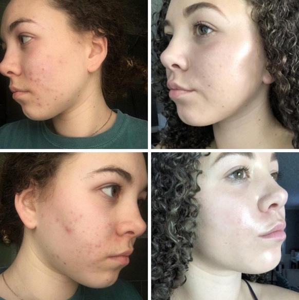 Секреты от девушек, которым удалось сделать кожу своего лица совершенной: всего несколько минут в день - и проблем как не бывало