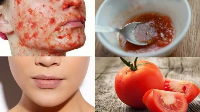 Натуральные маски из помидор, куркумы, меда помогут восстановить кожу и избавиться от угревой сыпи