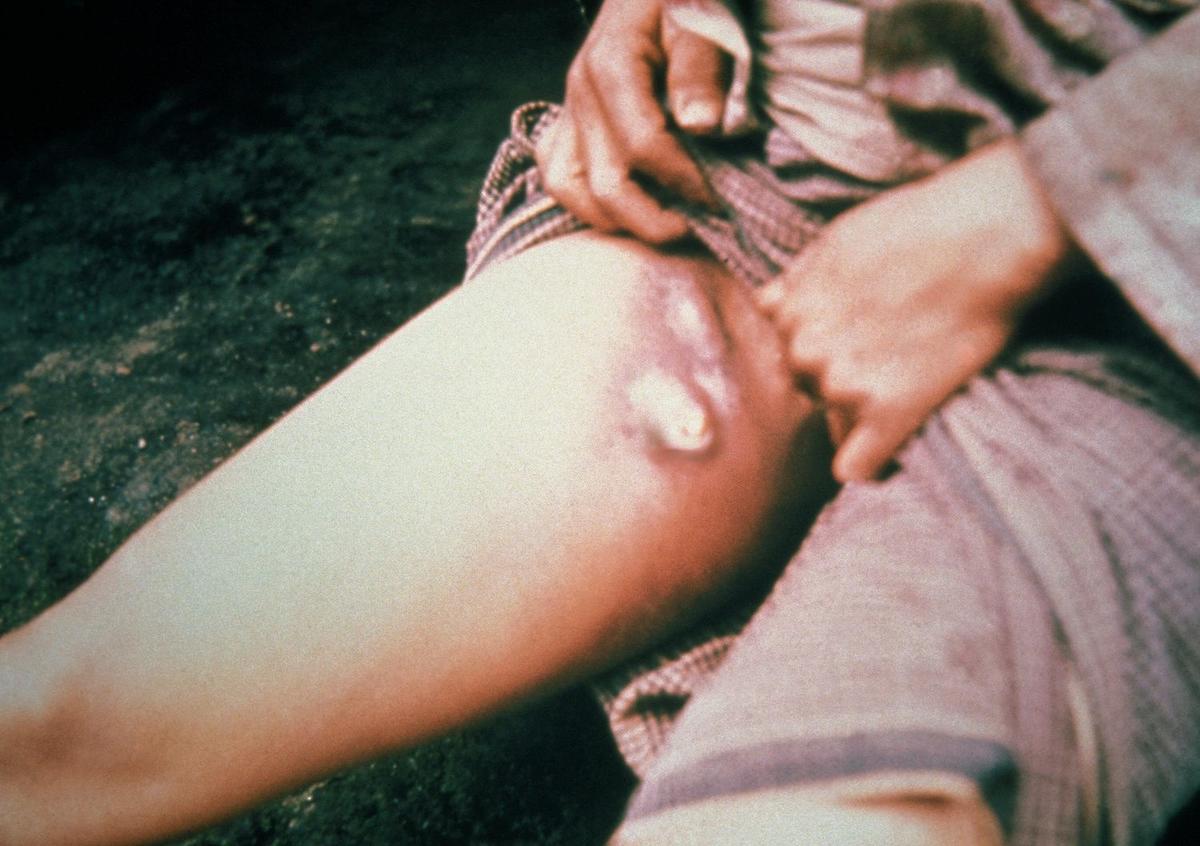 Планете опять угрожает бубонная чума — одна из самых страшных инфекций в мире