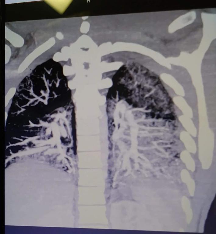 Ужасные сканы лёгких показывают, во что они превращаются из-за вейпов