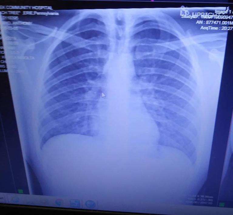 Ужасные сканы лёгких показывают, во что они превращаются из-за вейпов