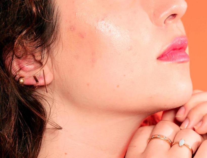Прыщи на щеках - от генетики, а на носу - из-за вида кожи. Что вызывает акне в разных частях лица