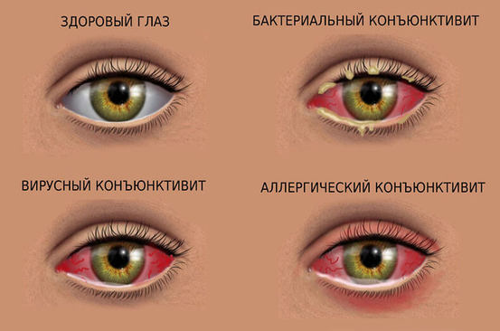 Коньюктивит: эффективное лечение натуральными средствами