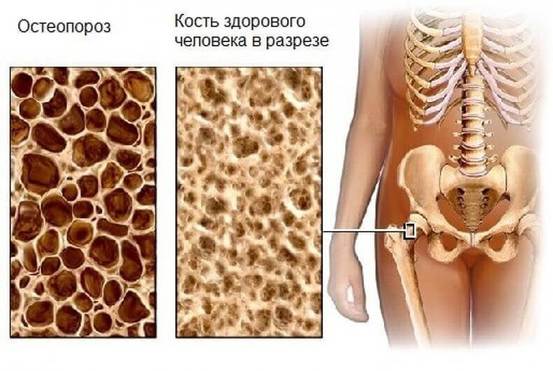 Правда об остеопорозе