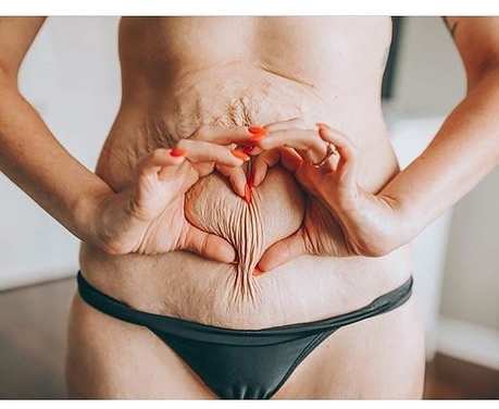 Без прикрас: Женщины показали, как на самом деле выглядит тело после родов