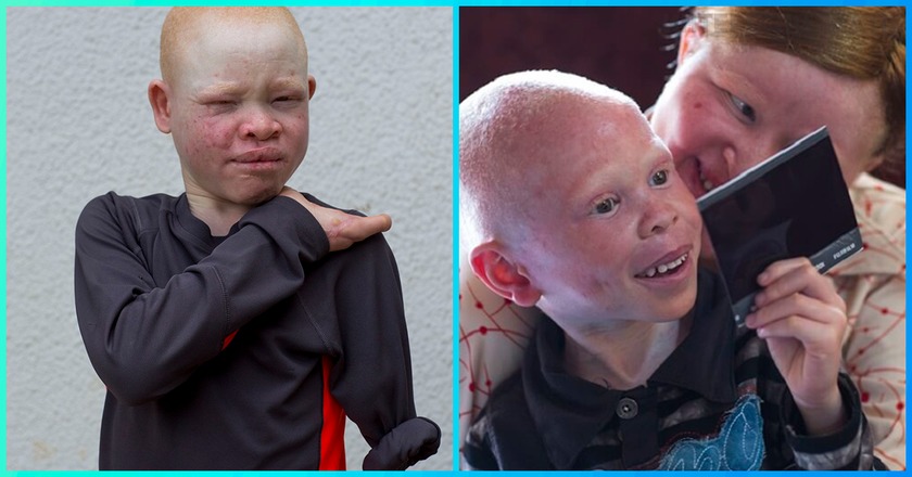 «Отрезают руки и ноги»: тела танзанийских альбиносов стоят дороже золота