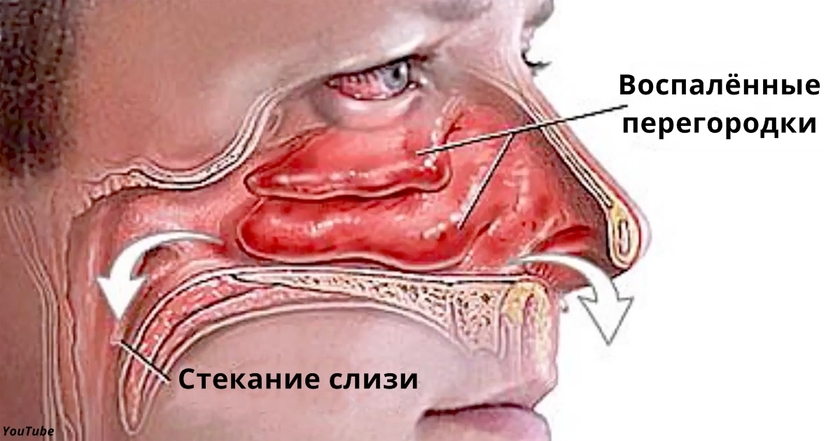 Вот как за пару минут избавиться от насморка