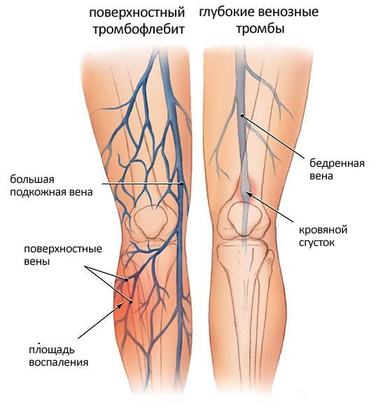 Как избежать операции при тромбофлебите 