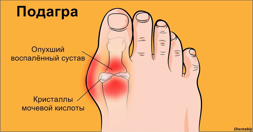 Вот как справиться с подагрой дома и без сверхусилий! 