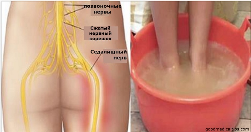 От боли в седалищном нерве можно избавиться за 10 минут! Рассказываю! 